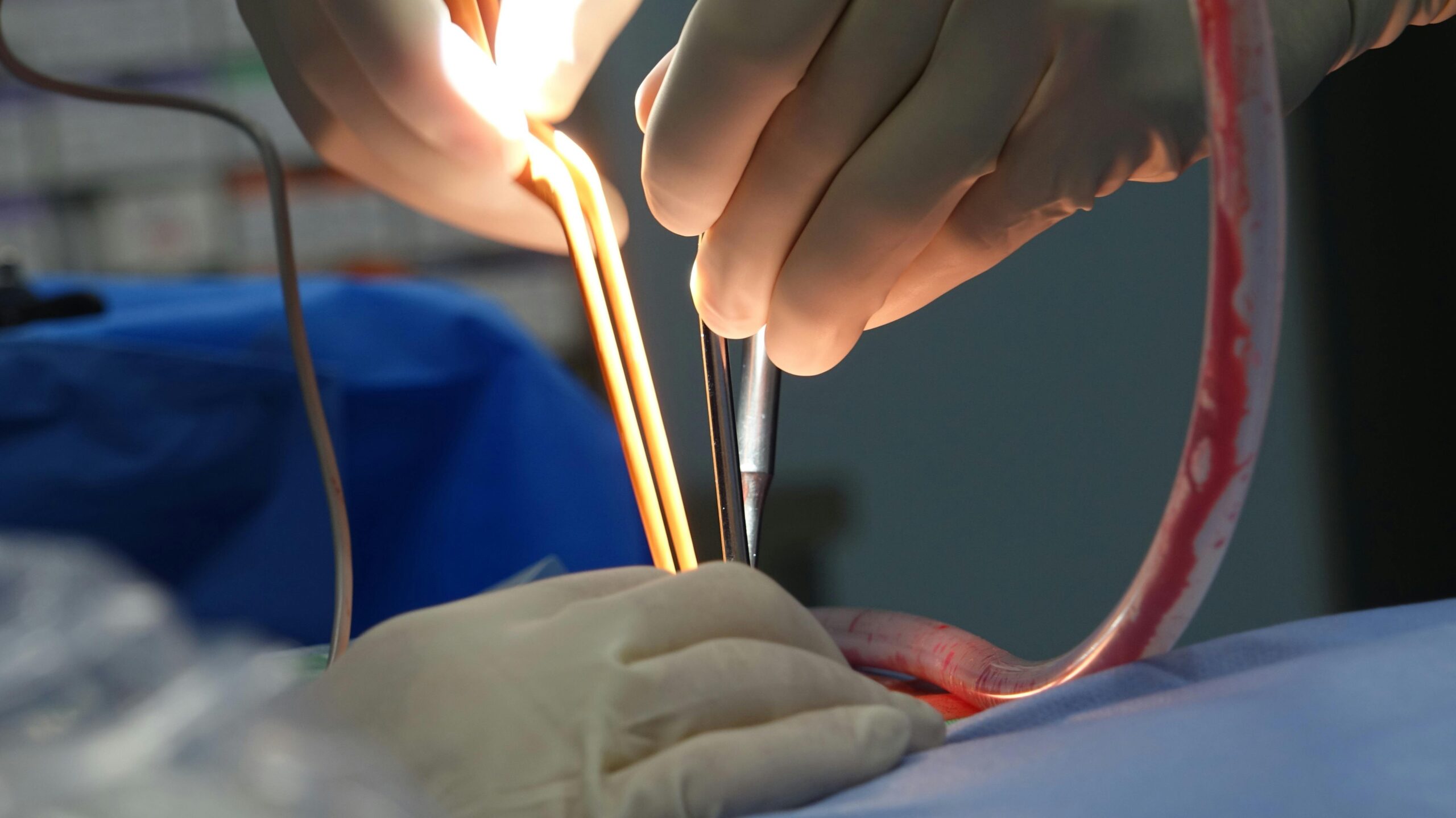 Percutaneous Nephrolithotomy: Procedure, Risks, and Recovery Essential guide to percutaneous nephrolithotomy, a key procedure for removing large or complex kidney stones when less-invasive methods fail.